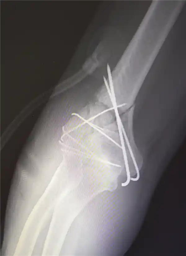 男子13米坠落重伤 医生拼图手术奇迹救回