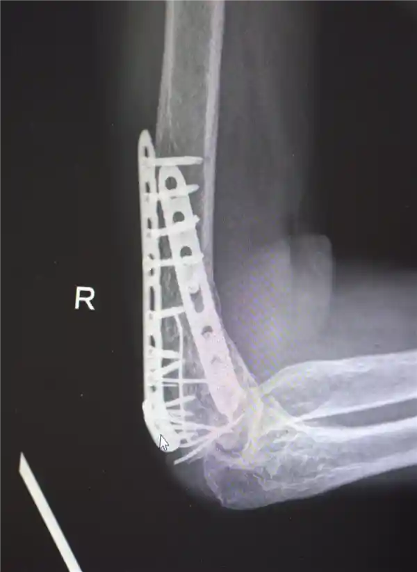 男子13米坠落重伤 医生拼图手术奇迹救回