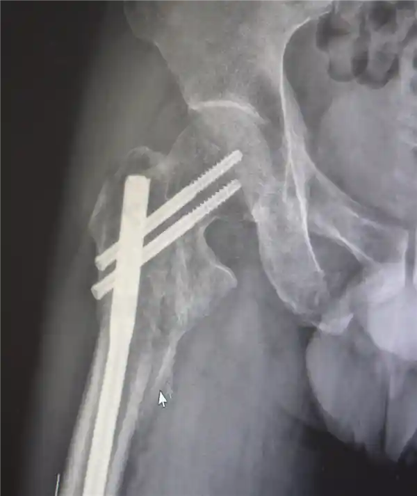 男子13米坠落重伤 医生拼图手术奇迹救回